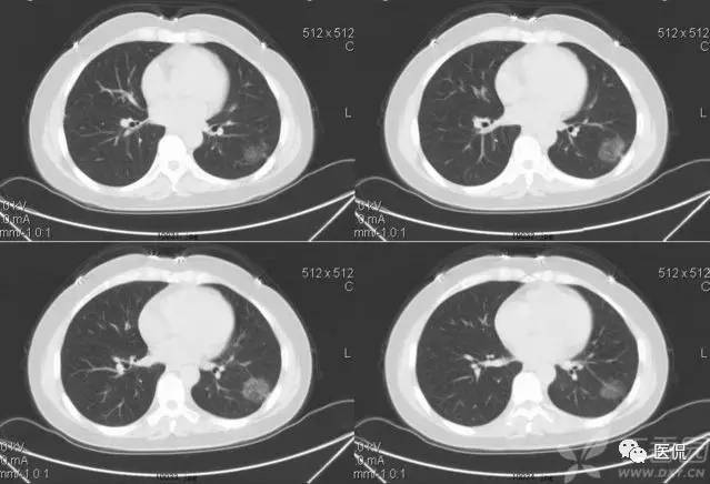 影像学呼吸系统理论知识,呼吸系统疾病影像学常见征象