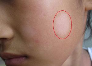 被医院皮肤科误诊了怎么办,皮肤科常见病褐色斑