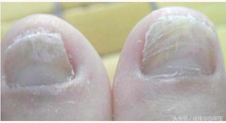 灰指甲与增厚型灰指甲的区别,灰指甲抠掉还会出现灰指甲吗
