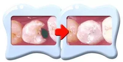 虫牙有一个洞可以补好吗,牙虫洞比较浅是怎么补的