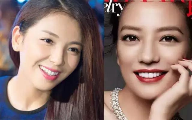 整牙=整容?看杨幂、刘涛、高圆圆为你亲身示范!