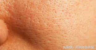 皮肤科医生毛孔粗大有黑头,黑头毛孔粗大看皮肤科有用吗