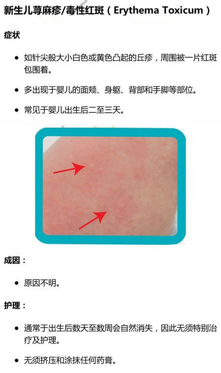 湿疹or热痱，傻傻分不清!八种宝宝常见皮肤问题及护理指南
