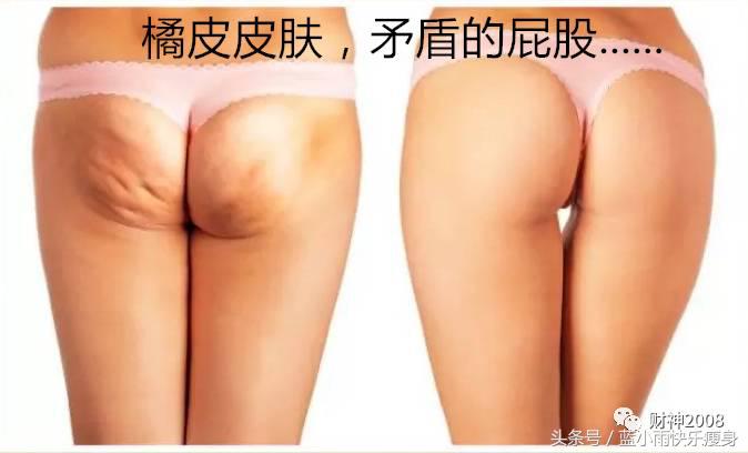 快速减肥导致橘皮纹,快速减肥后皮肤松弛了怎么办