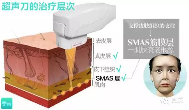 青春定格？4D埋线？音波拉皮？别晕，面部提升就那老三样