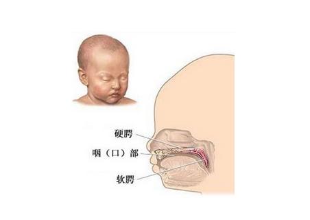 新生儿腭裂1度怎么治疗,腭裂语言矫正训练有效的办法