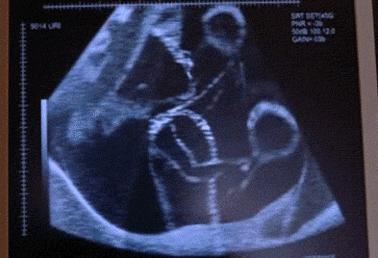 怀孕28周数胎动的正确方法,怀孕28周胎动比较少怎么数胎动