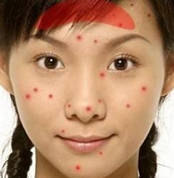 脸上长痘痘是什么原因一碰就疼,脸上长痘痘是什么原因怎么解决