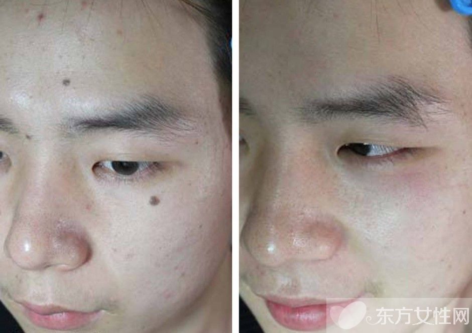 激光点痣痂掉了后红印要注意什么,点痣后注意事项及解决方法