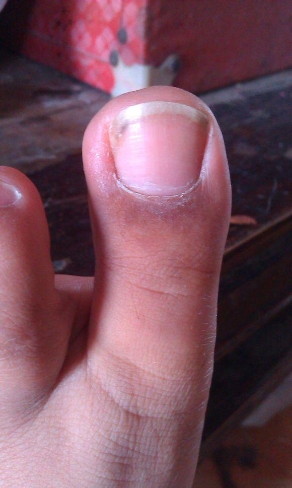 甲沟炎塞棉花法管用吗,甲沟炎塞棉花视频教程