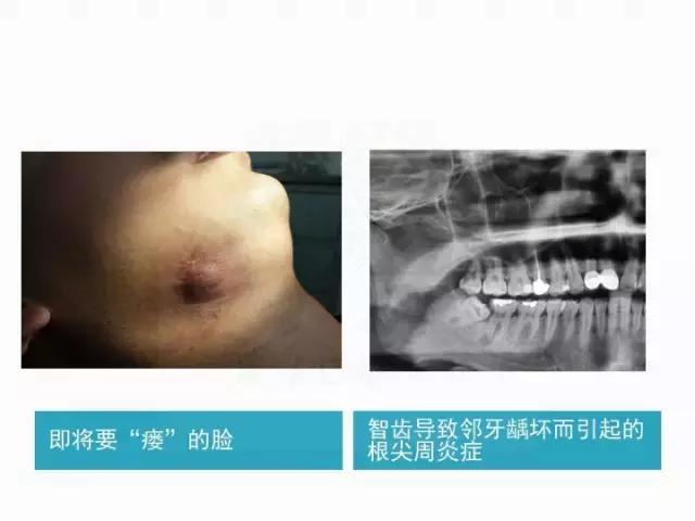 厉害了！她用缝衣针来治疗牙疼