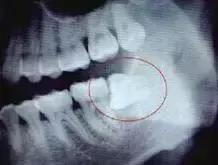 下颌阻生齿拔除技巧,下颌阻生智齿拔除会面瘫吗