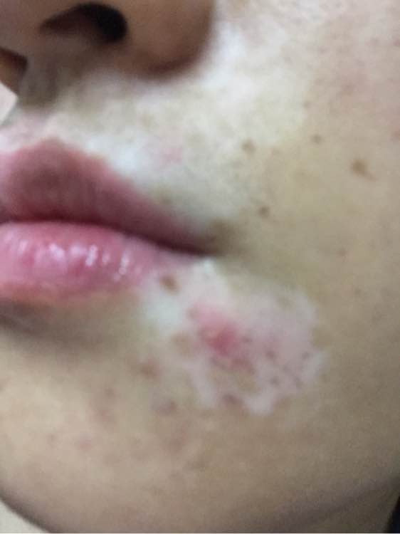 白斑光照,白斑光照后图片