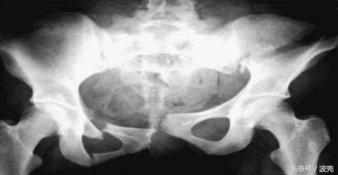 南方女婴一生下来就要折断盆骨？有点残忍但也很无奈