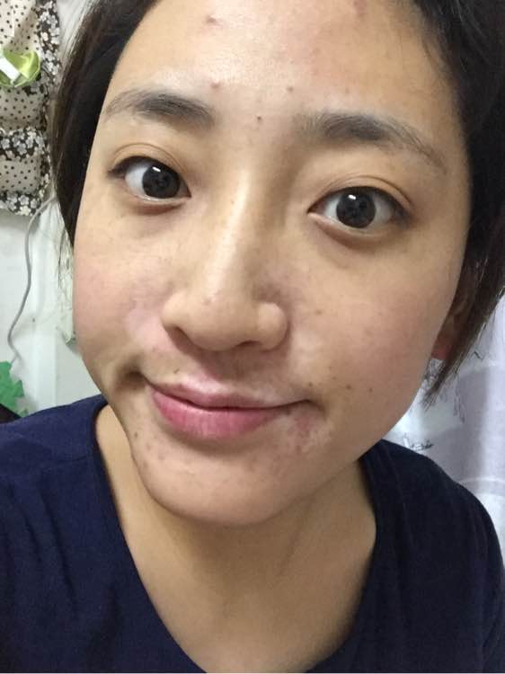 白斑光照,白斑光照后图片