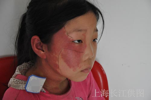 昔日胎记女,今日嫁给相同胎记的救命恩人