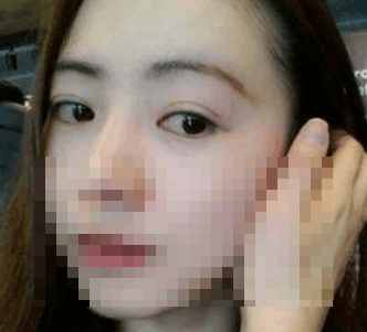 埋线双眼皮的正确操作手法,埋线双眼皮很浅