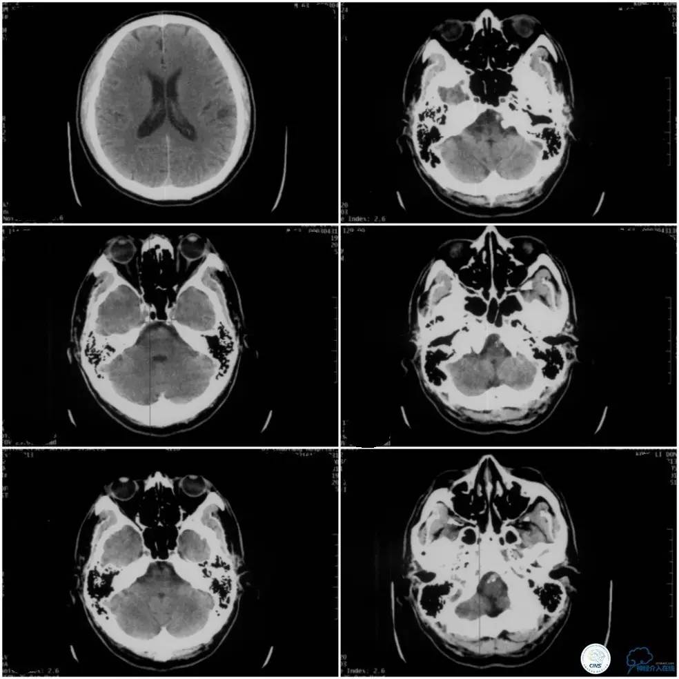 天坛周记|基底动脉狭窄合并动脉瘤血管内介入治疗一例