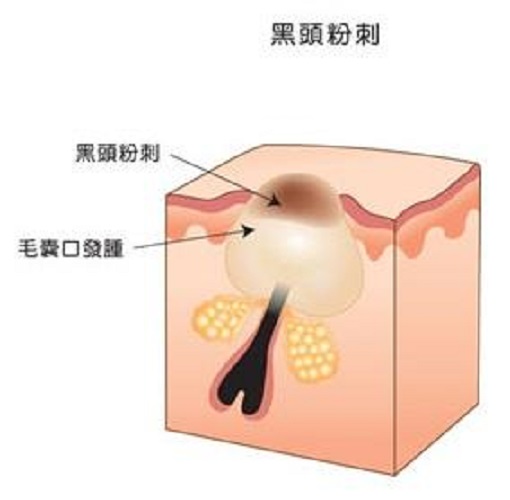 黑头有啥办法去除吗,黑头要怎么去掉