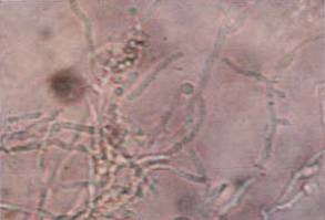 红色斑丘疹是湿疹吗,红斑丘疹误诊湿疹