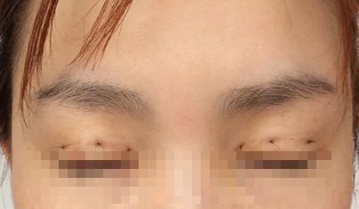 割双眼皮选医生真实经验分享,割双眼皮不能不知道的7个潜规则