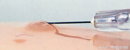 过敏原检测一般能不能查出过敏原,反复过敏怎么查过敏源