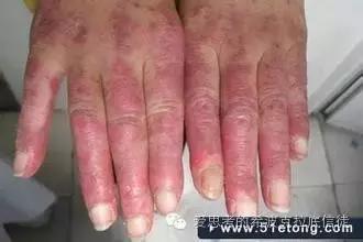 病毒狼疮,病毒引起的多形红斑狼疮