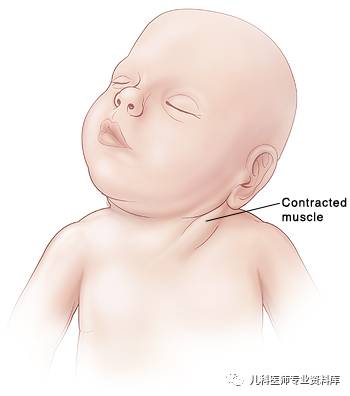 痉挛性斜颈患者说出了大秘密,痉挛性斜颈脖子歪照片