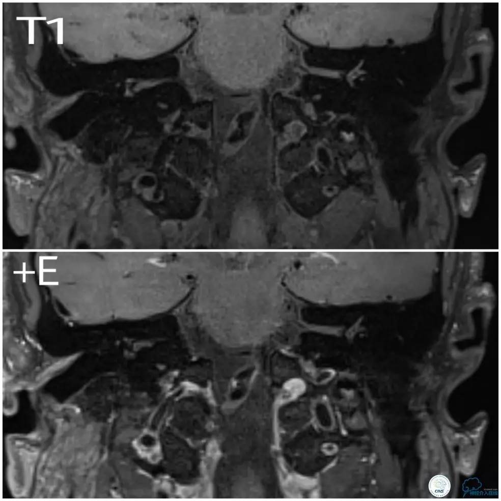 天坛周记|基底动脉狭窄合并动脉瘤血管内介入治疗一例