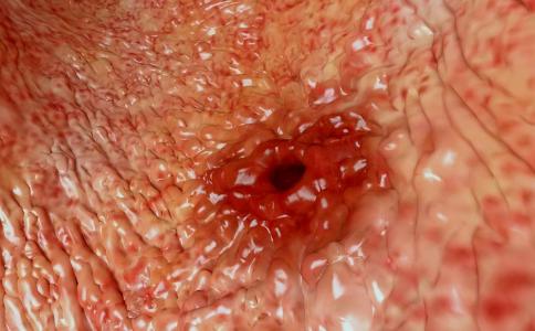 胃穿孔严重吗胃穿孔怎么治,胃穿孔症状治疗