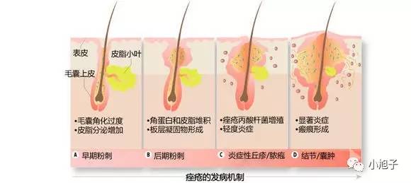 闭口痘痘的痘印可以消除吗,痘痘痘印闭口怎么彻底去除