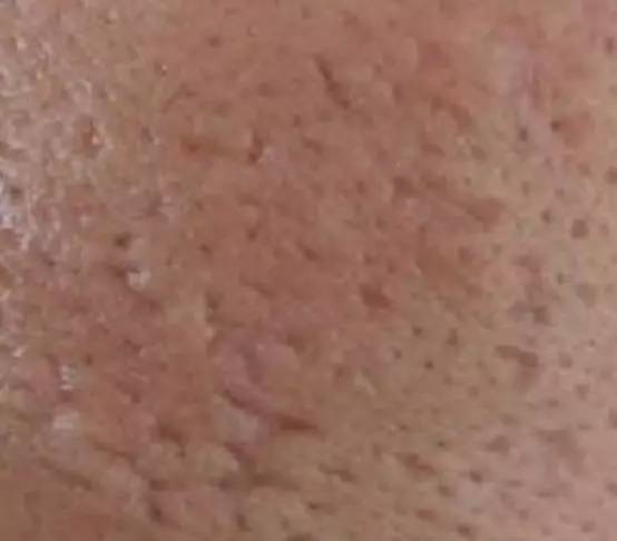 脚受伤有疤痕怎么处理,鼻子受伤疤痕怎么处理