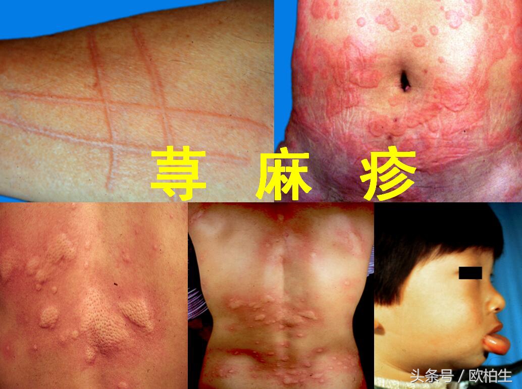 慢性荨麻疹中医辨证治疗方法,慢性荨麻疹怎么治才能去根