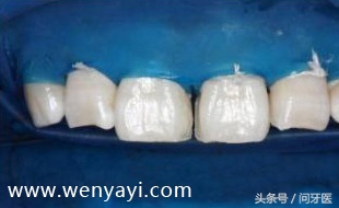 门牙有缝是什么说法,门牙有缝怎么办如何补救