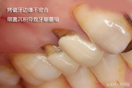 烤瓷牙真的不好吗,被牙医骗了做了烤瓷牙