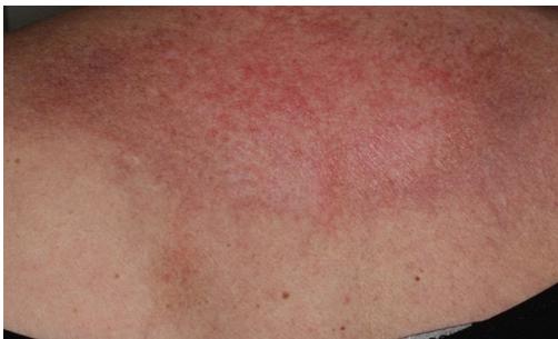 皮肌炎和多发性肌炎是什么样的疾病？