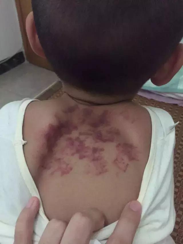 儿童咳嗽快速止咳小妙招支气管炎,儿童急性支气管炎的最佳止咳方法