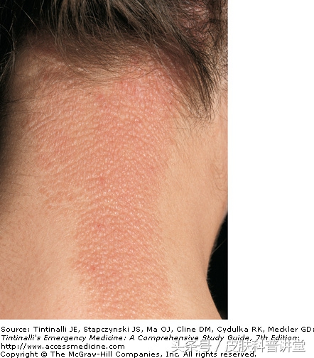 反复神经性皮炎是缺什么,神经性皮炎反反复复如何根除