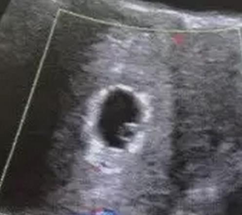 自己怎么判断是否胎停,胎停究竟该如何判断