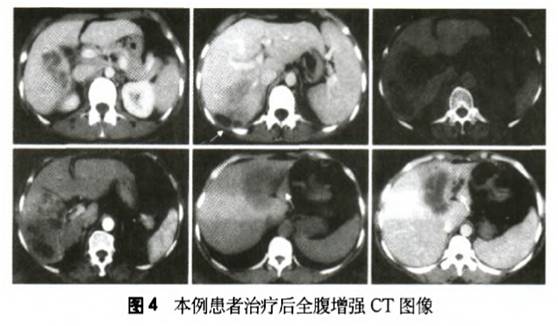 病检嗜酸性粒细胞增多提示啥病,嗜酸性粒细胞升高并且腹痛