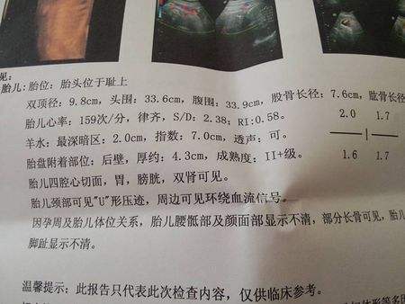 羊水过多的孕妈怎么办,孕妇羊水过多怎么改善