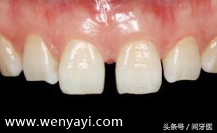 门牙有缝的女人有什么不好,门牙有缝怎么办如何补救