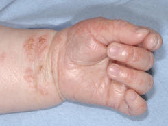 小孩出湿疹最好的解决办法,孩子湿疹更需要被重视