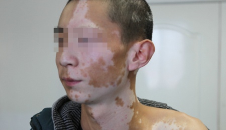 怎样治疗白癜风效果好呢,肢端型白癜风用308治疗有效吗