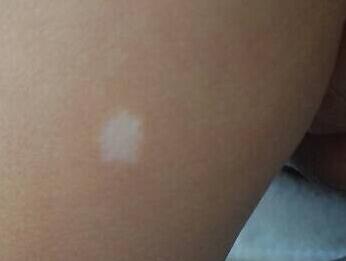 白癜风得病原因和治法,白癜风发病跟饮食有关吗