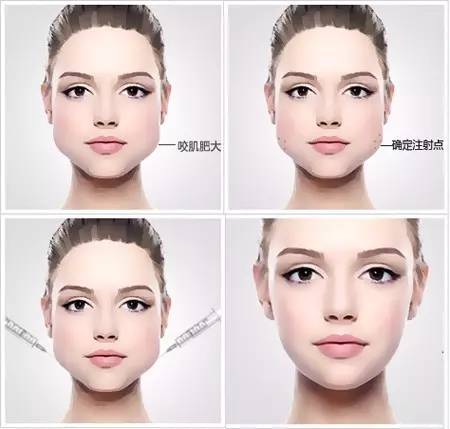 哪种脸型不能打瘦脸针,哪些脸型不适合打瘦脸针