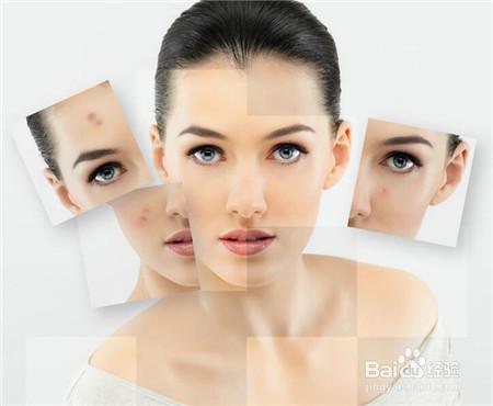 粉刺和痘痘有什么区别,粉刺和痘痘的区别图片