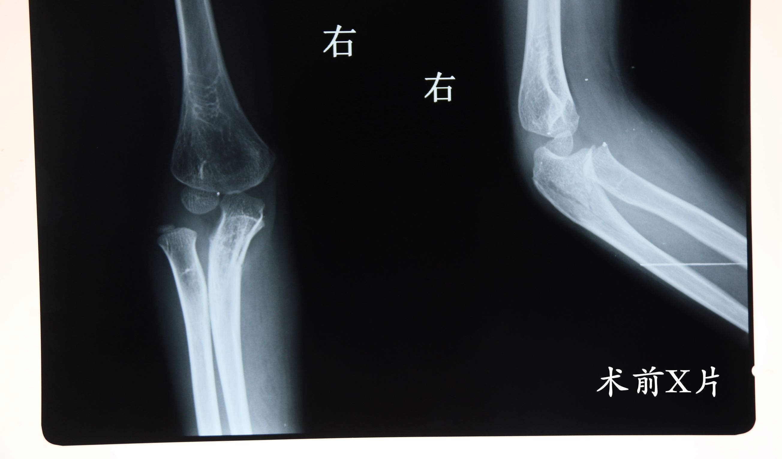 孩子胳膊摔伤后伸不直怎么办,小孩摔了跤胳膊伸不直是怎么回事