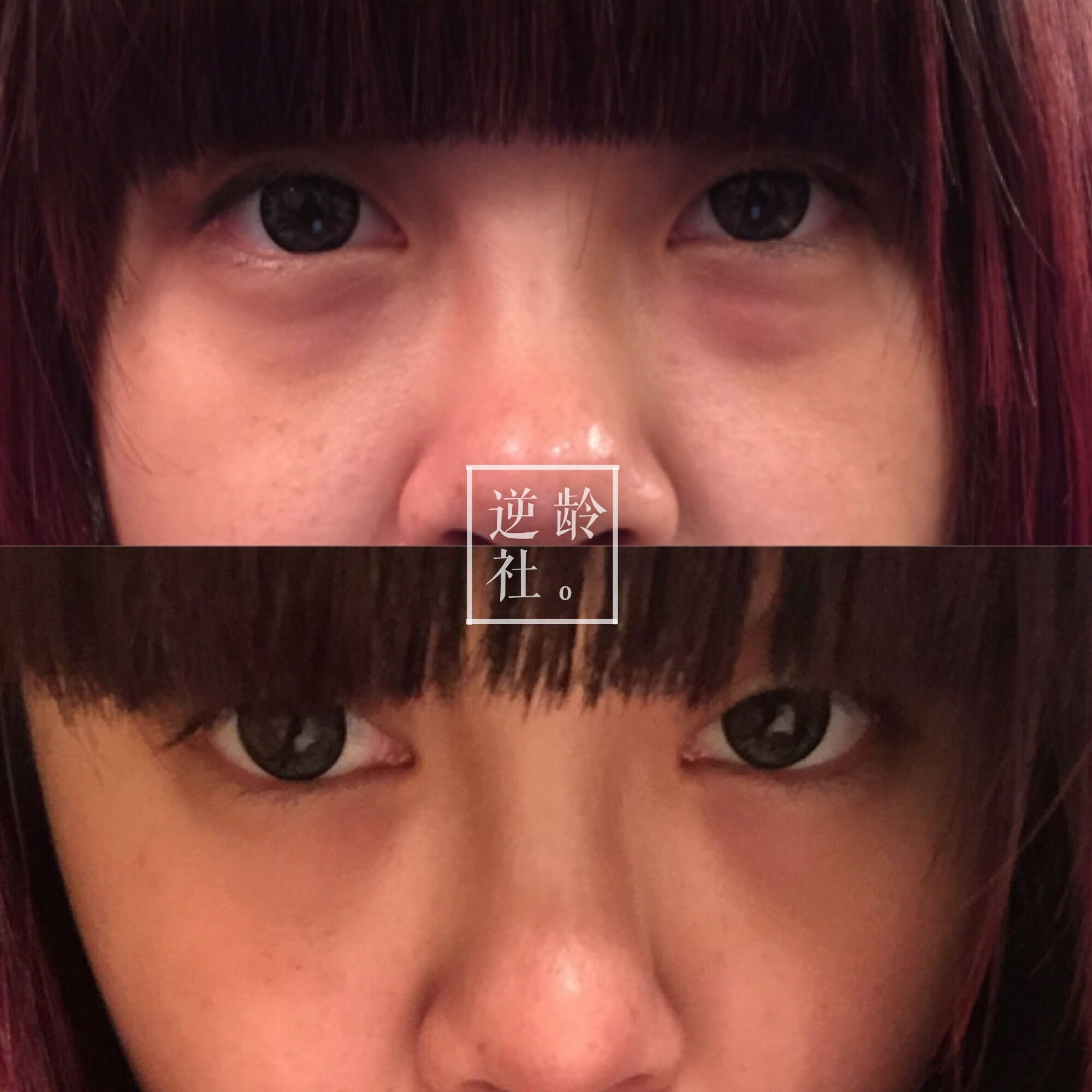 已经做了超声刀如何补救,逆龄精雕好还是超声刀好