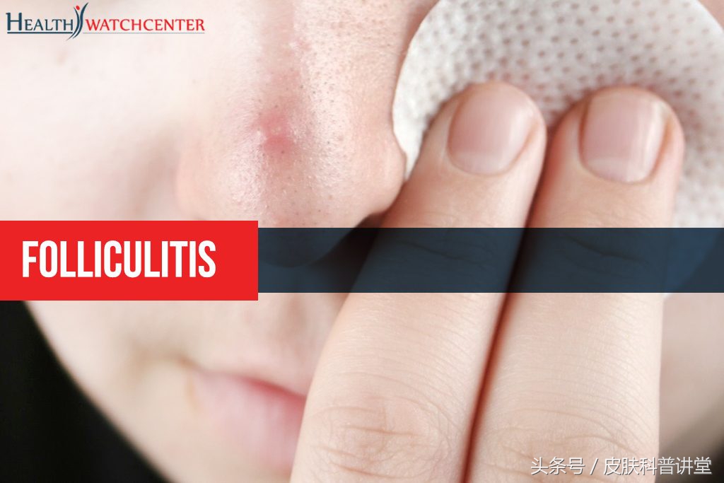 皮肤毛囊炎最简单自愈方法,皮肤科普小讲堂第一讲